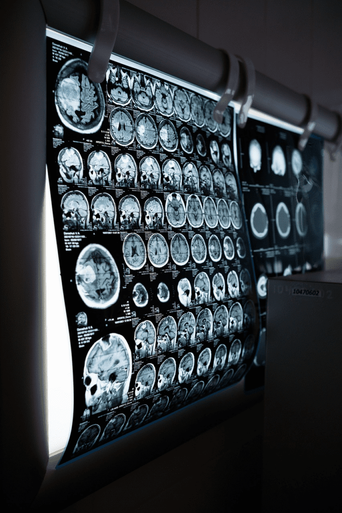 Qué enfermedades se detectan con una resonancia magnética cerebral