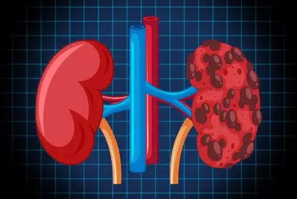 Ecotomograf a Renal Evaluaci n Y Detecci n De Enfermedades ImatecSalud