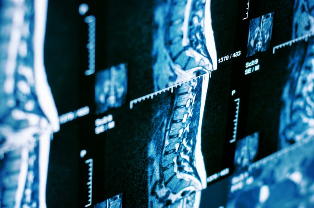 Qué muestra una resonancia de columna y cuándo está indicada