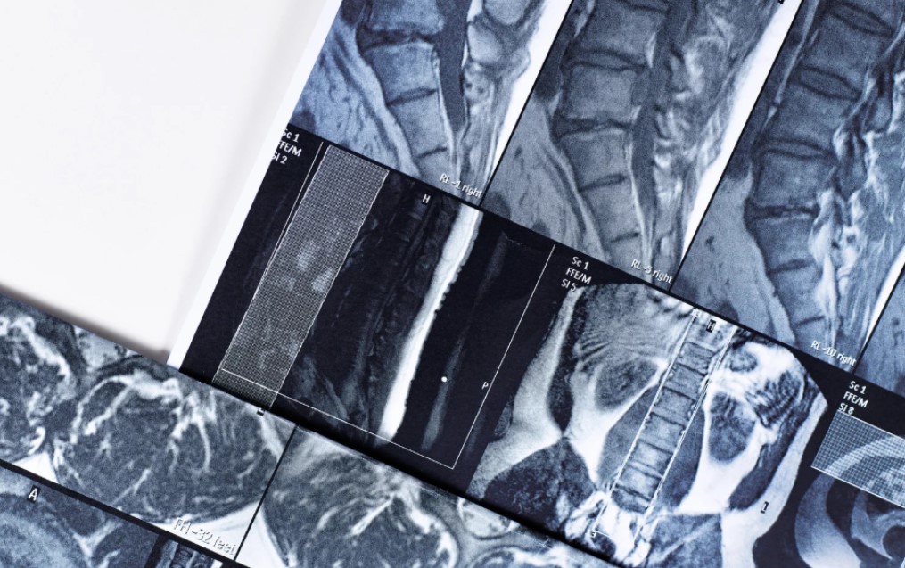 Cuándo hacerse una resonancia magnética