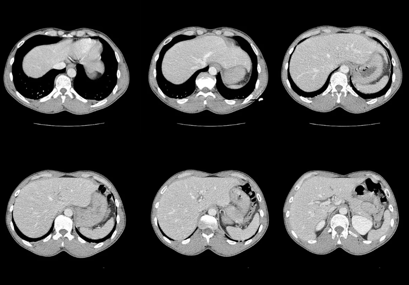 Beneficios de la tomografía computarizada de cráneo encefálica